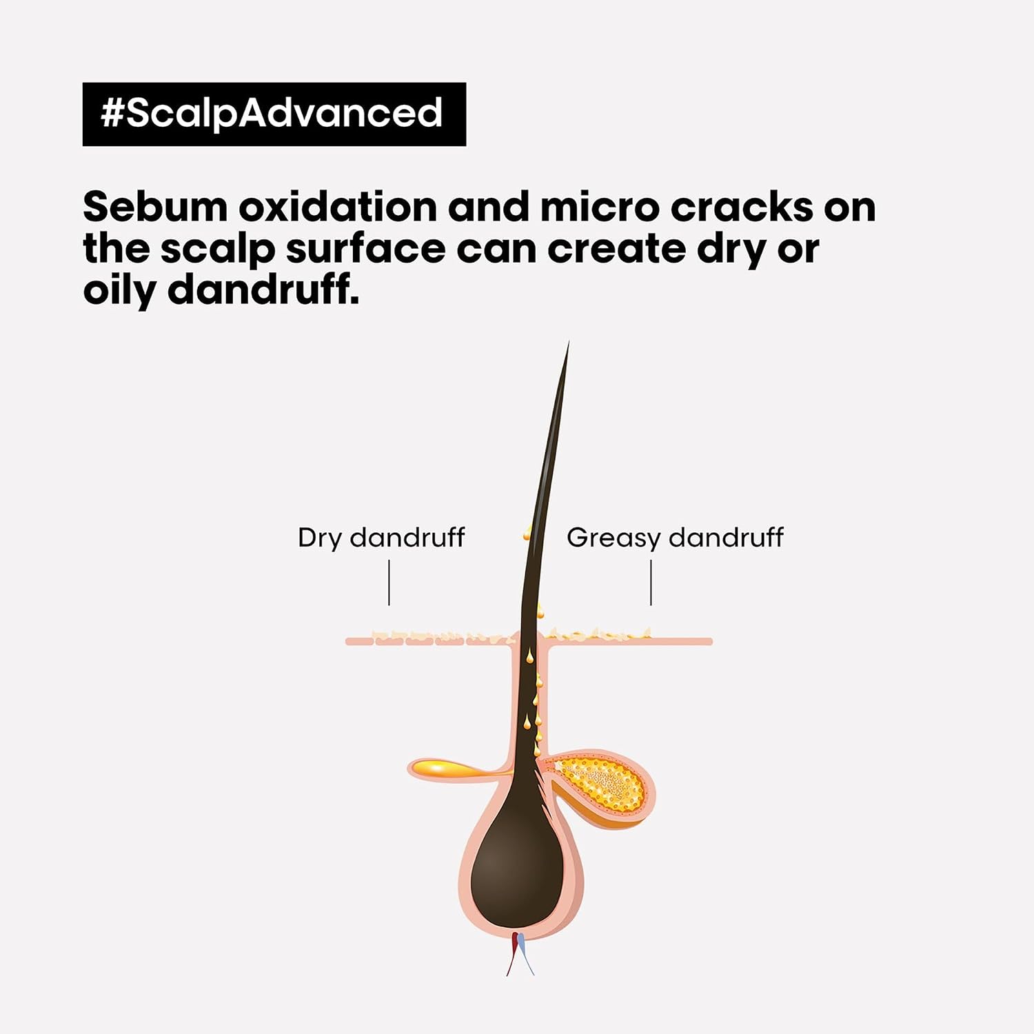 L’Oréal Professionnel Scalp Advanced Anti-Discomfort Intense Soother Treatment | Salon Grade Treatment For Sensitive Scalps | Enriched with Niacinamide | Soothes & Hydrates the Scalp |with Niacinamide | 300 ml
